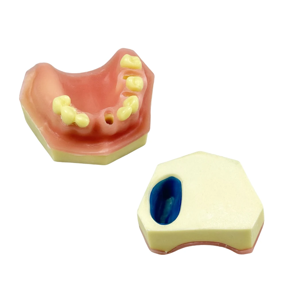 1pcs Dental Implant Model Maxillary Sinus Implant Missing Tooth Model Dental Research Teaching Model