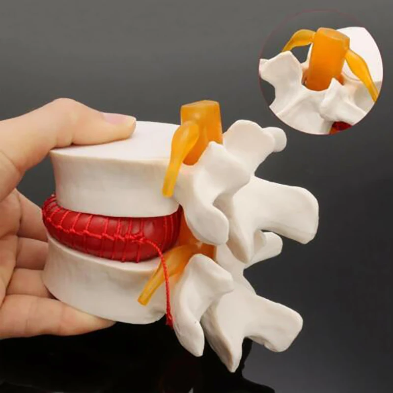 APHRODITE 1:1.5 Human Lumbar Disc Herniation Teaching Model of Lumbar Vertebral Spine Anatomical Models Soft Enlarge White