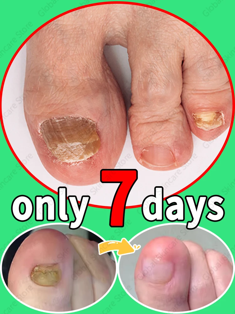

Say goodbye to onychomycosis, no recurrence, no damage to nails