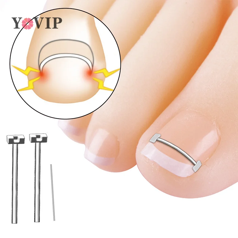 10 Stuks Ingegroeide Teennagel Corrector Tools Pedicure Herstellen Insluiting Teen Nagel Behandeling Professionele Teennagel Correctie Voetverzorging Tool