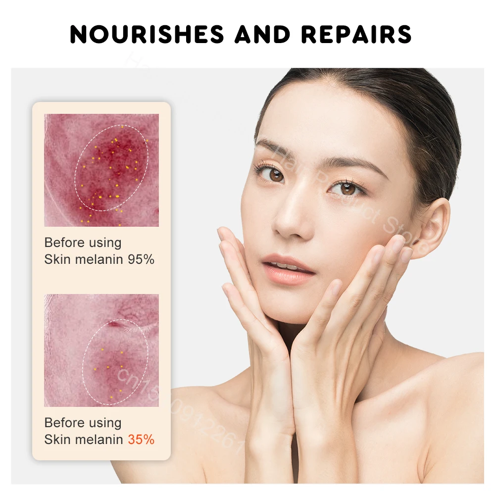 Herbal Acne Face Cream Pimple Scar Remover Gel Oil Control Shrink Pore Pockmark Smooth Acne Marks Facial Cream Skin Care Product