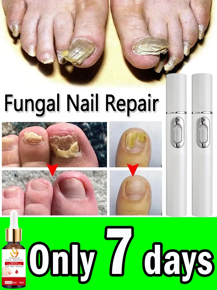 Nail Device Repair Toe Foot Essence