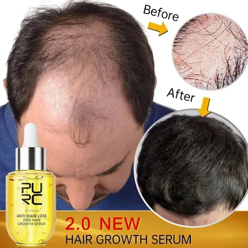 PURC-suero para el crecimiento rápido del cabello para hombres y mujeres, aceite de jengibre para el cuidado del cabello, tratamiento anticaída del cuero cabelludo, productos de belleza para la salud, 2023