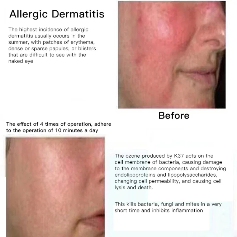 ozone plasma pen acne treatment device beauty instrument Blemish Removal Dead Skin Removal Skin Rejuvenation Skin Mouisture