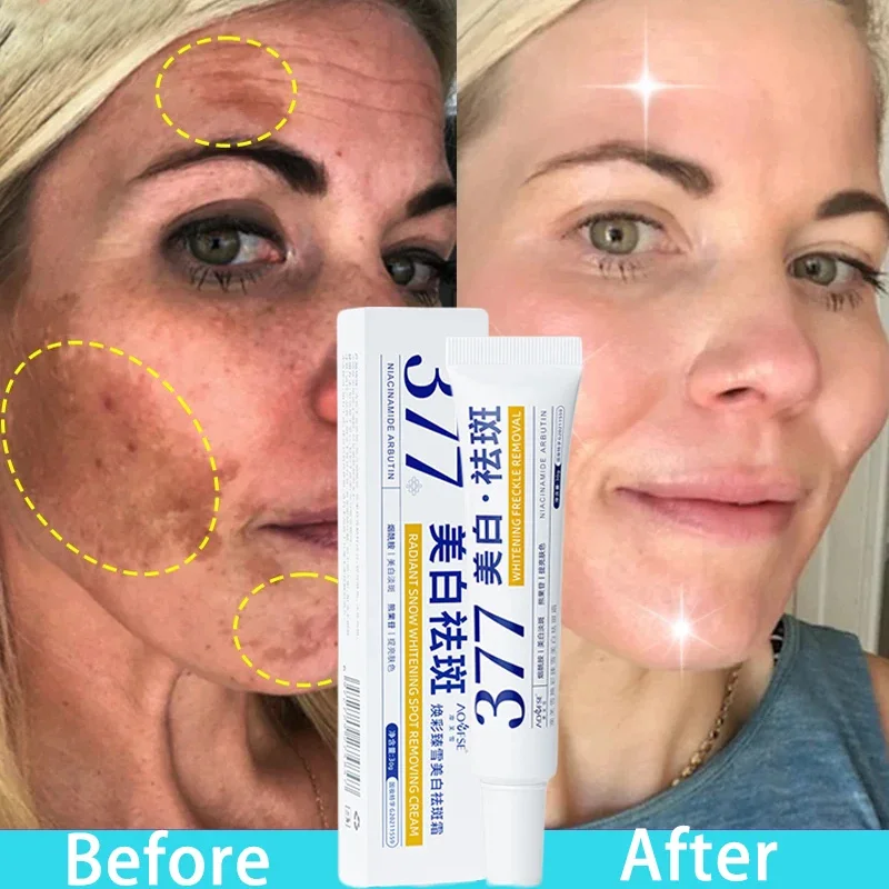 

Whitening Freckle Cream Melasma Dark Spots Pigmentation Removal Products Fade Stain Melanin Repair Brighten Korean Skin Care