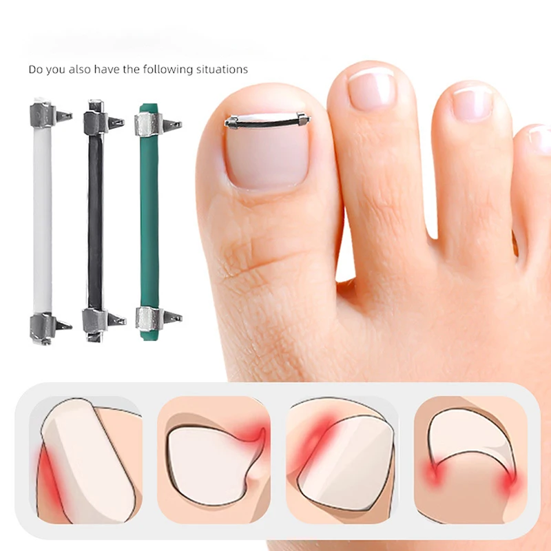 Ferramenta de pedicure incorporar correção de cuidados unha encravada toe alisamento clipe curvo braçadeira unhas dos pés para dedos dos pés