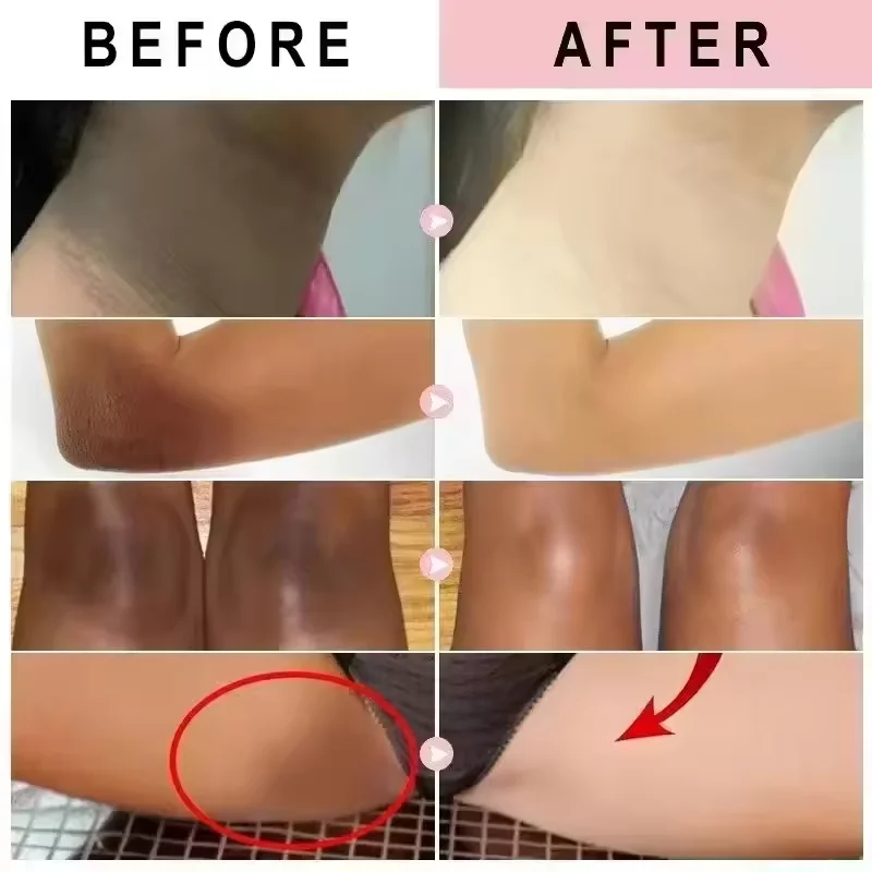 Remove Melanin Body Whitening Snow Bleach Cream Brighten Underarm Elbow Knees Joint Lighten Intimate Part Thigh Inner Dark Spot