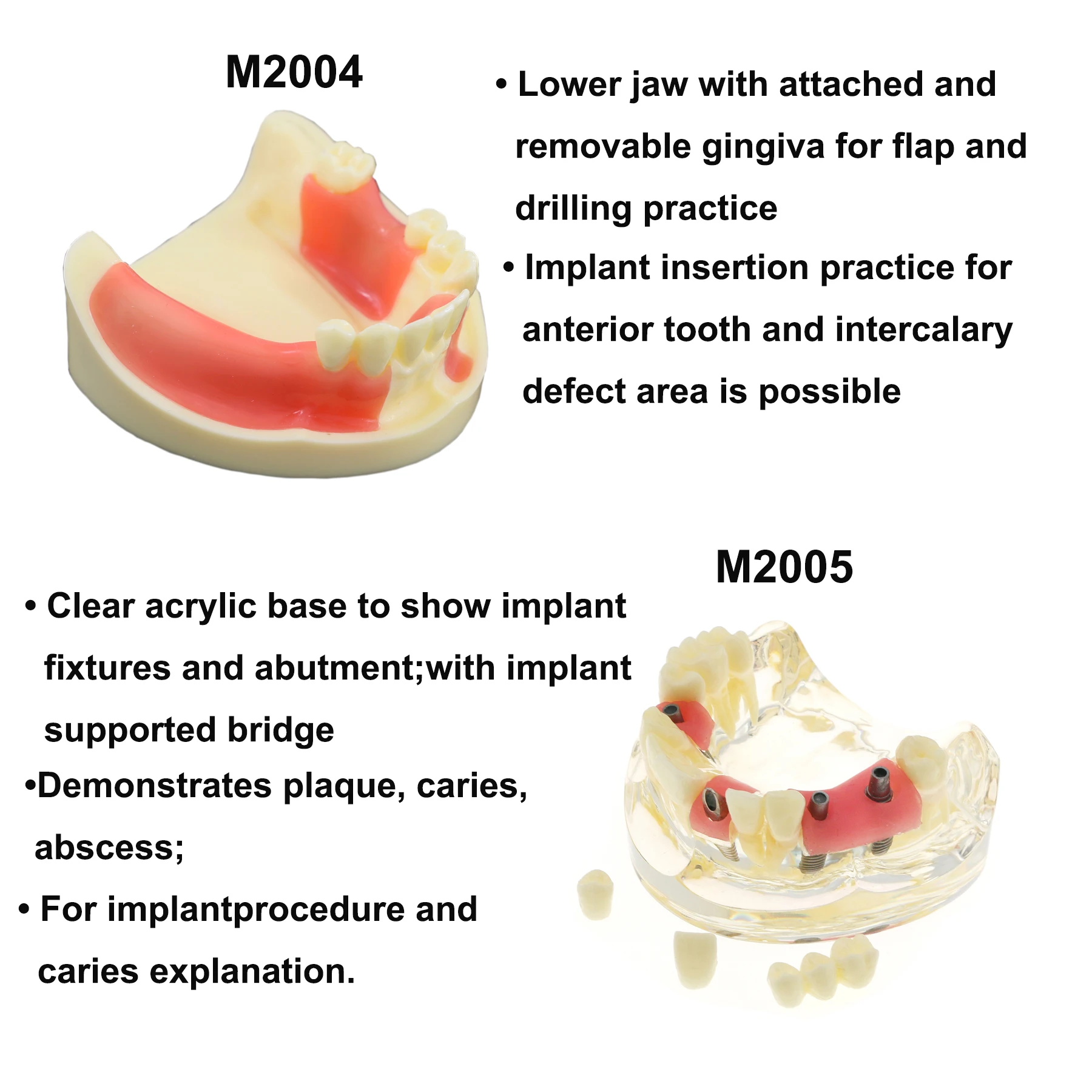 Teeth Implant Model Dental 2/4 Implant Overdenture Restoration Upper Lower Teeth Model Typodont  Implant Procedure