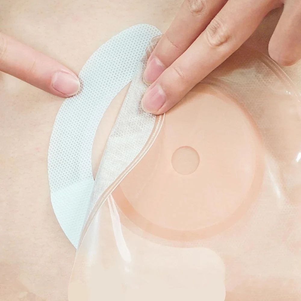 

20Pcs Disposable Elastic Ostomy Barrier Strips Hydrocolloid Waterproof Leak Skin Adhesive Ostomy Barrier Tape for Colostomy Bag