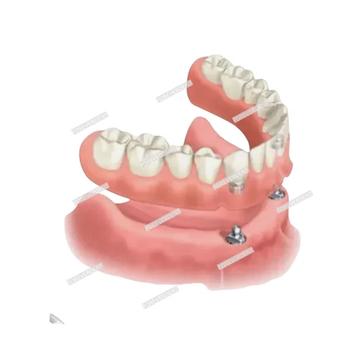 Imagen 2 del producto Kit de tapa de junta tórica Dental OSS, tapas de retención, bola de retención de sobredentadura, carcasa de Metal 4N, 4 unidades/Kit