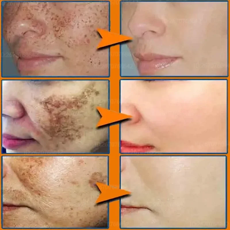 Gesicht Melasma Creme aufhellende dunkle Haut Emulsion aufhellende Melanin aufhellen Creme für stumpfe Haut Frauen feuchtigkeit spendende Produkte