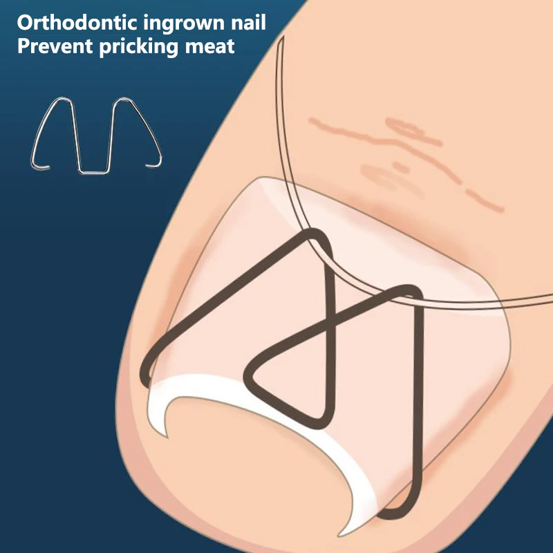 3 pary wrastających paznokci narzędzie do korekcji wrośnięty palec u nogi terapia na paznokcie haczyk z gwoździem/gumki klip do prostowania Pedicure