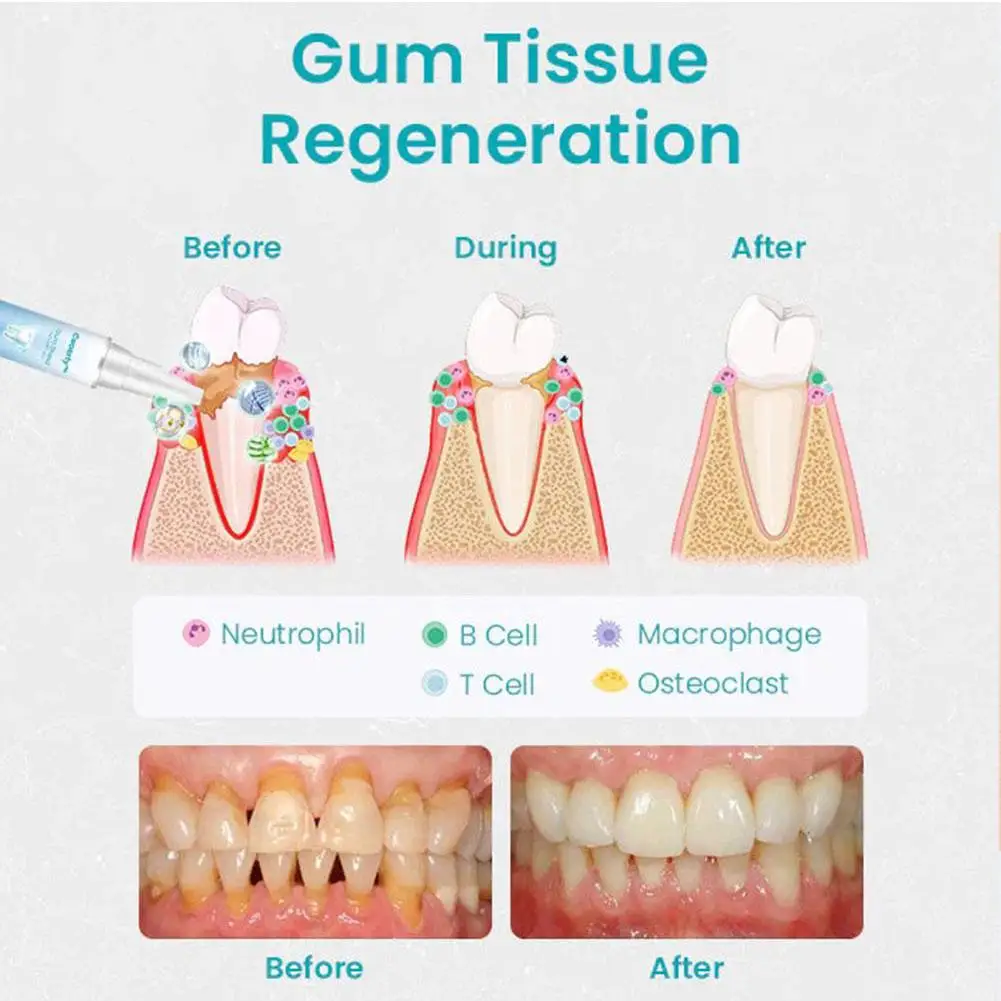 4ml Gum Therapy Gel Teeth Whitening Essence Pen, Fast Teeth Whiten Teeth, Clean Remover Teeth Stain Deep Care Effective Ora H3S8