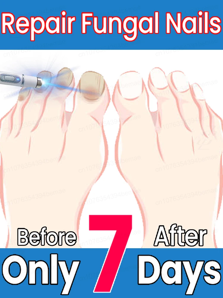 Unhas lisas e limpas, não mais preocupações sobre onicomicose