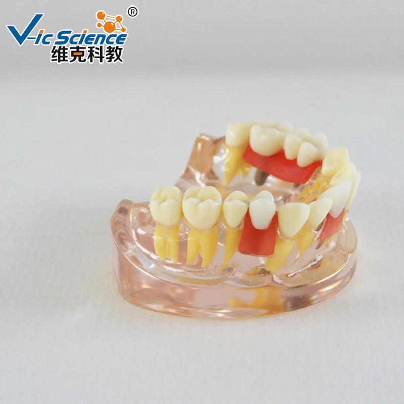 Modelo de demonstração de implante Modelo de implante dentário de meia boca