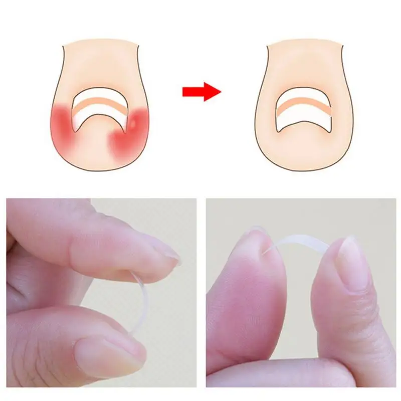 Outil de Correction des ongles incarnés, 100 pièces, traitement des ongles incarnés, Patch élastique autocollant, Clip de redressage, attelle, outil de pédicure