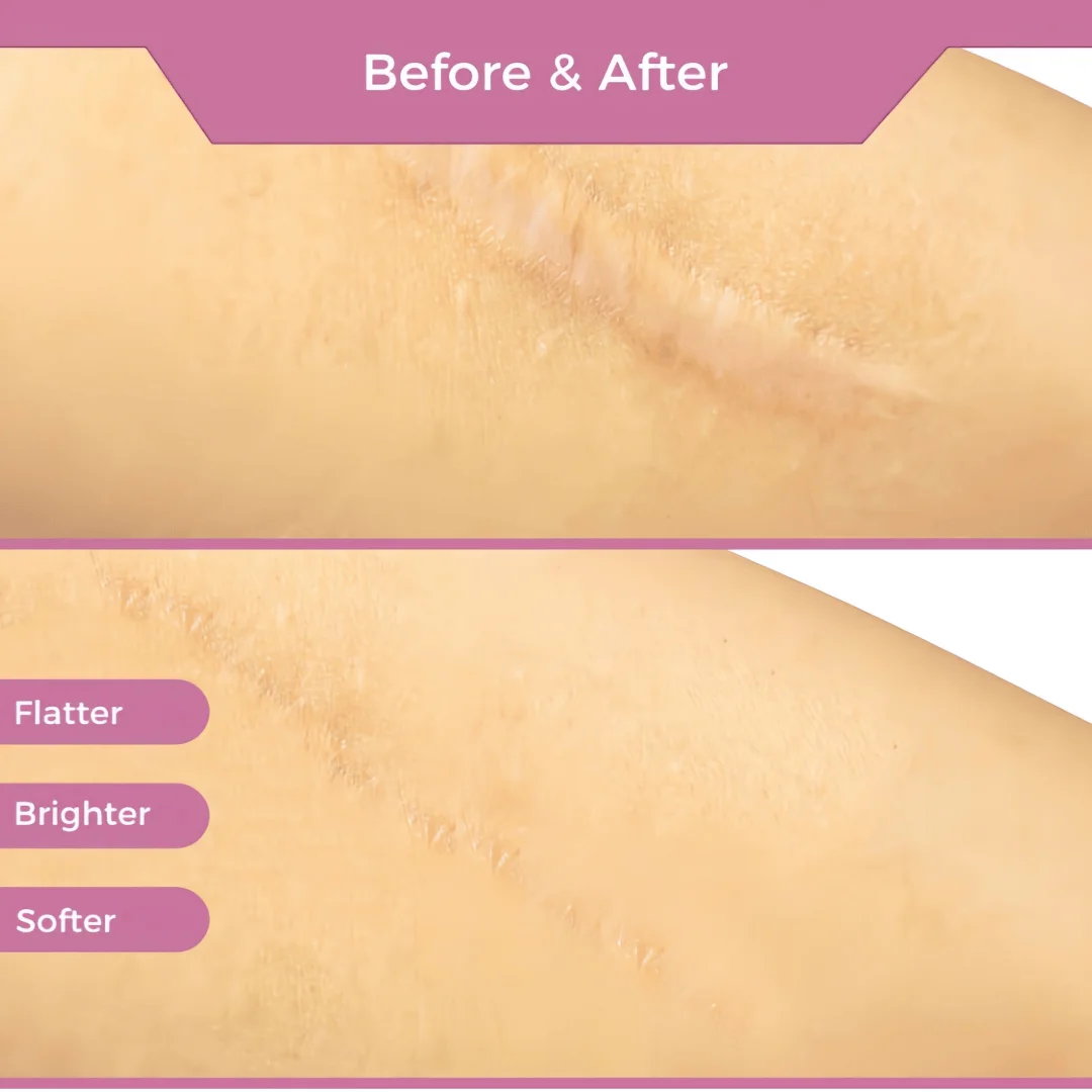 1/2-pcsMedical Silicone Scar Tape, 4.1cm x 4.4cm, Hypoallergenic for Surgical Scars & Abdomen.