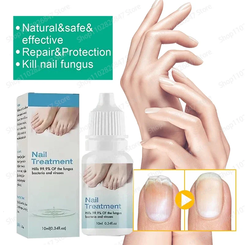 Suero para tratamiento de hongos en las uñas, Gel líquido para reparación de pies, eliminación de hongos en las uñas de los pies, aceite antiinfección para paroniquia y onicomicosis, 7