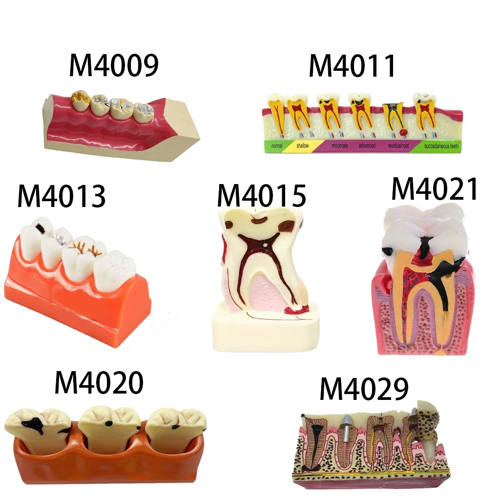 

Dental Caries Classify Model of Pathological Process Lower Right Posterior Teeth Tissue Decomposition Treatment Removable Study