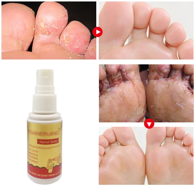 

20ml Herbal Athlete Foot Anti-fungal Spray Remove Foot Odor Beriberi Itching Foot Care Repair Toe Ulceration Medical Spray Care