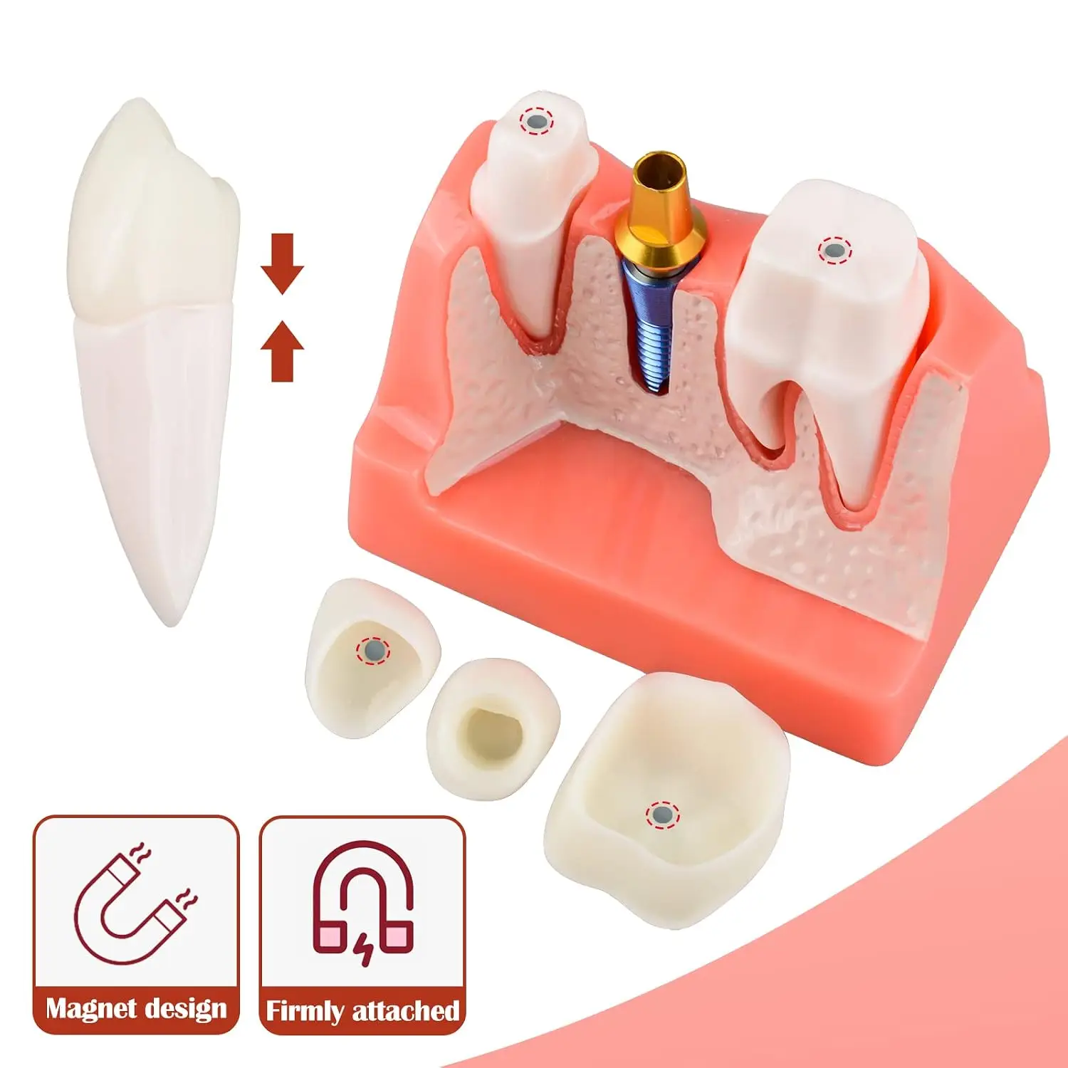 4 Times Dental Implant Model for Patient Education | Dental Implant, Crown and Bridge Model for Presentation-Pink
