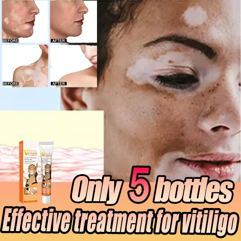 

White Spot Cream for Vitiligo White Spots Leukoplakia Pigmentation Melanin Promoting Vitiligo Cream Skin Care