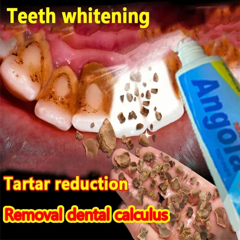 

Dental Calculus Remover Tartar Teeth Whitening