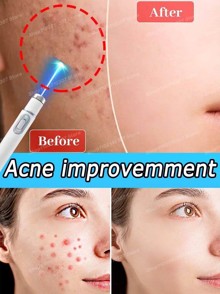 

Acne Cream Face Anti Marks Pimple Serum