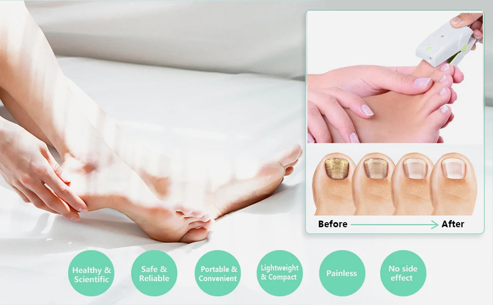 

Rechargeable Cordless Fungus No Messy Creams! Treats Onychomycosis & Mild Paronychia