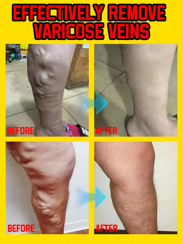 Varicose veins powerful laser