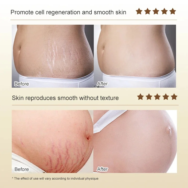 Stretch Marks Permanent Removal Cream Eliminate Body Belly Stretch Marks Swelling Marks Remove Skin Cracks Repair Firming Care