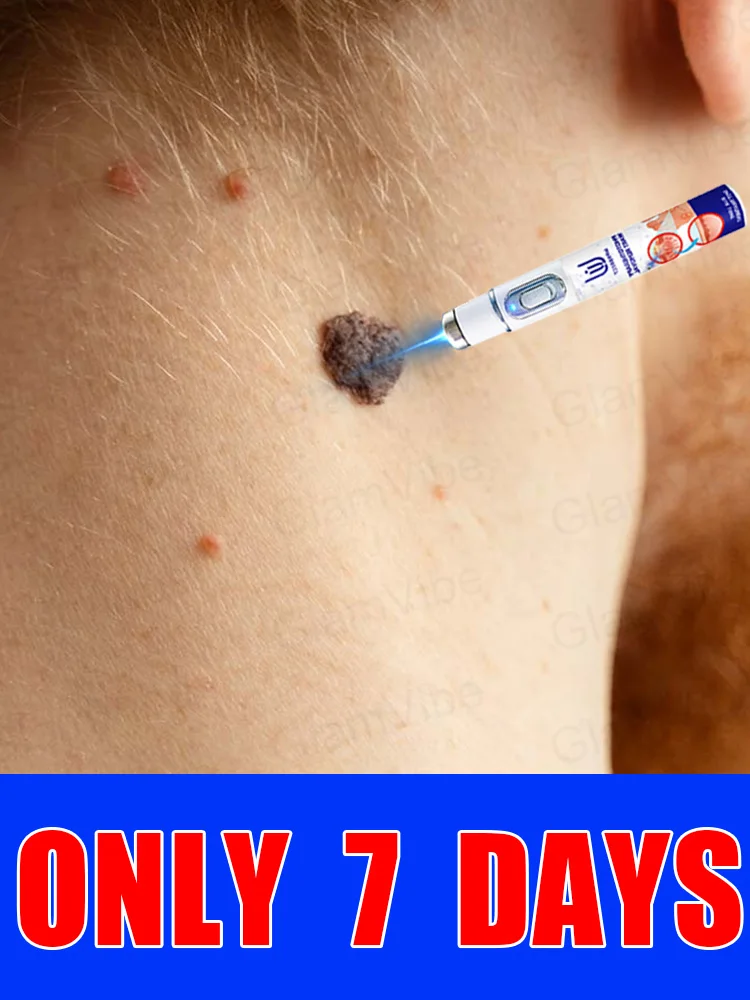 

2nd ᵍᵉⁿᵉʳᵃᵗⁱᵒⁿ ᵘᵖᵍʳᵃᵈᵉᵈ wᵃʳᵗ ⸴ ʳᵉpᵃⁱʳ wᵃʳᵗˢ ʳᵒoᵗ ⸴ ᑫᵘⁱᶜᵏˡʸ