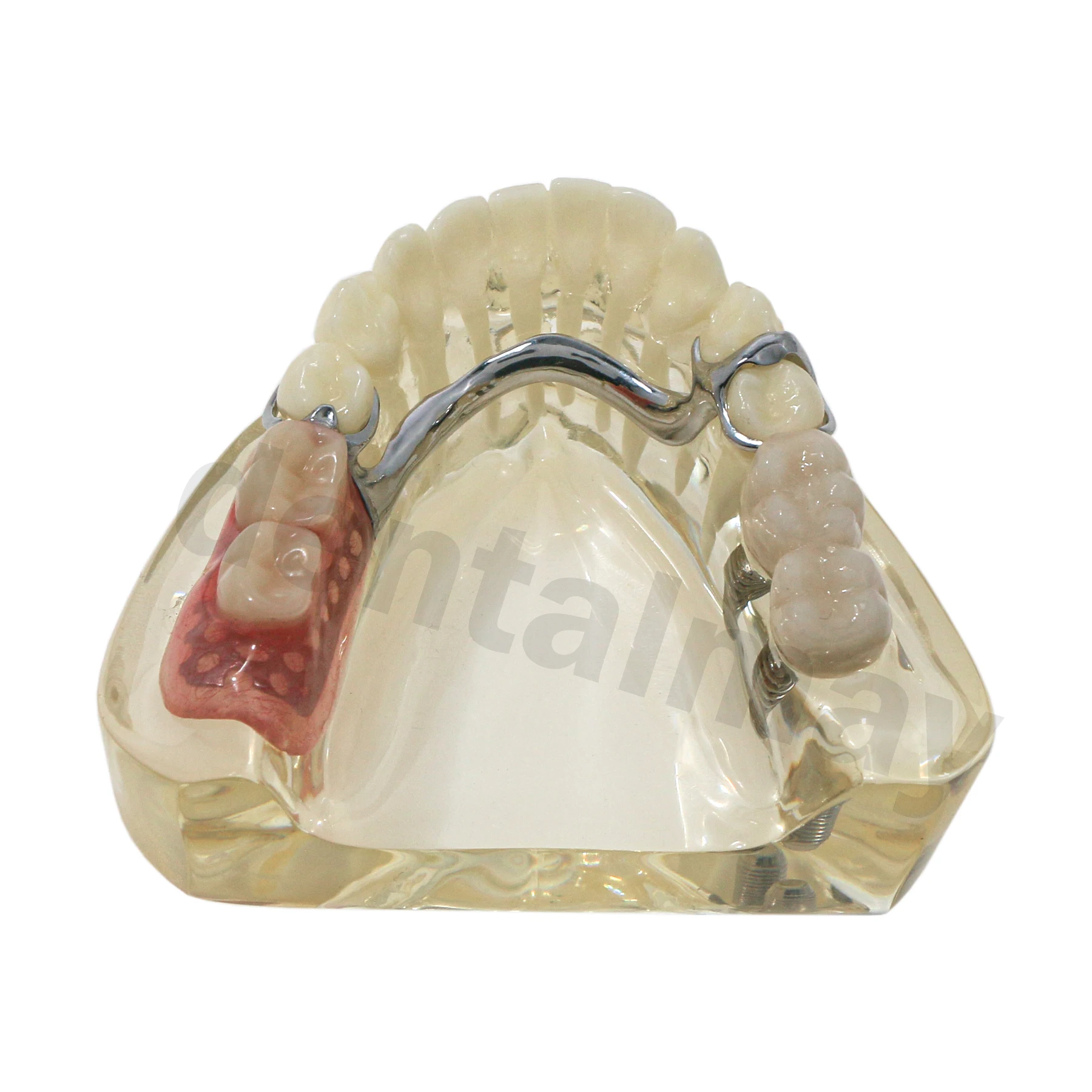 

Dental Teeth Model Typodont Implant and Restpration with Partial Denture M6022