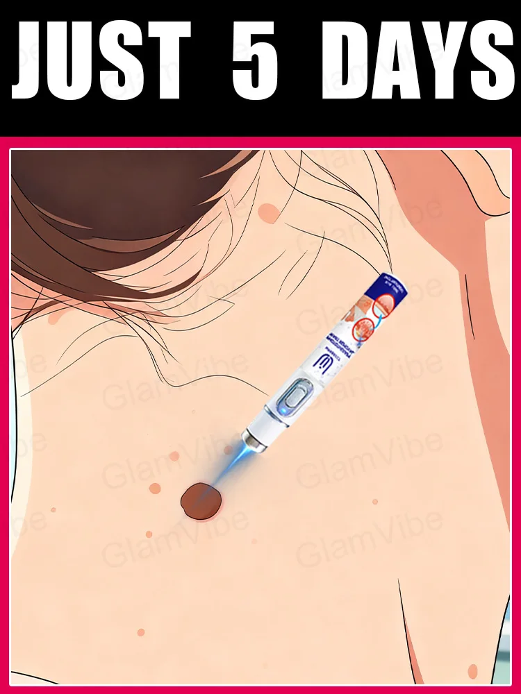 2025 New Upgrade Blue Laser Solve Wart Tool