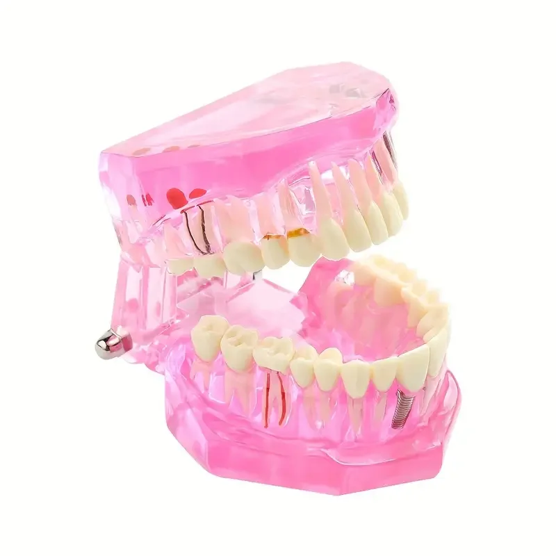 

Dental Implant Model Dental Consumables Removable Dental Restoration Model Pathological Tooth Model Active Tooth Model