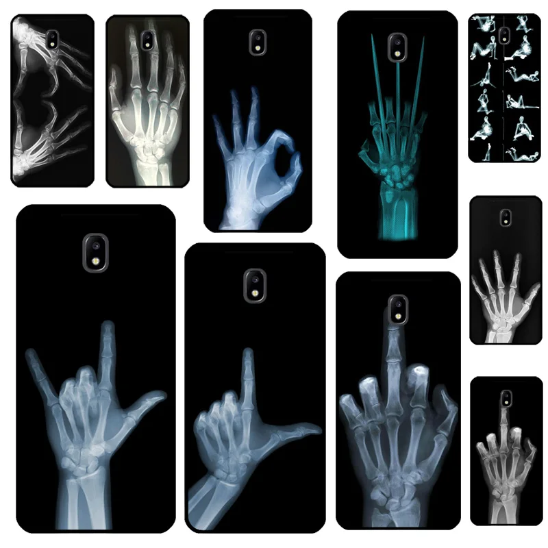 X-Ray Hand Bones Fo…