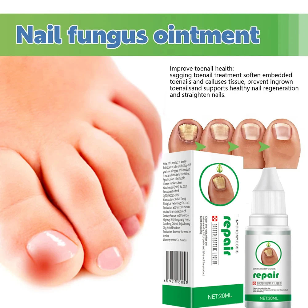 เซรั่มบำรุงเล็บจากเชื้อราที่เล็บ Onychomycosis paronychia ต้านเชื้อราติดเชื้อรานิ้วเท้าบำรุงเท้าสาระสำคัญดูแลอย่างรวดเร็ว7วัน