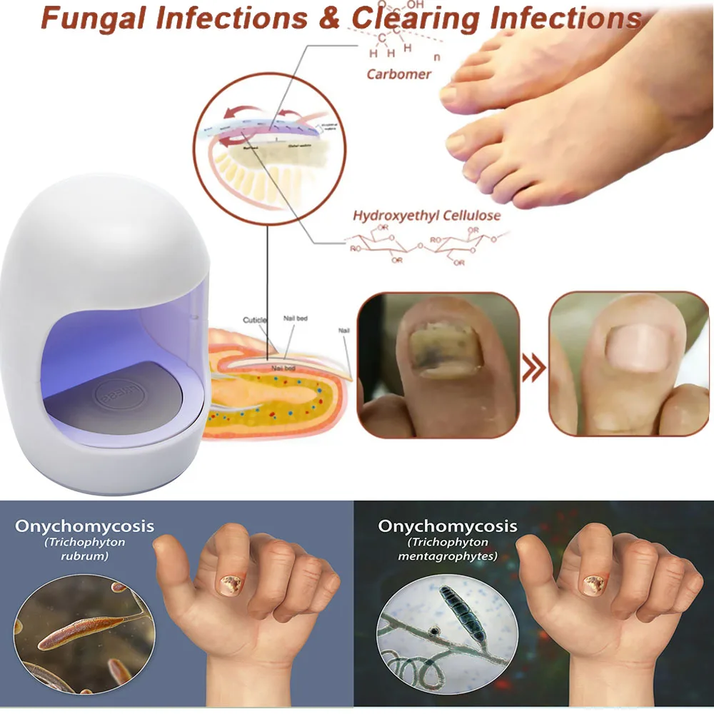 Fungus NailLaser Treatment Device Repair Toenail Fingernail Essential Oil Onychomycosis Treat Toenail Nail Fungal Treatment