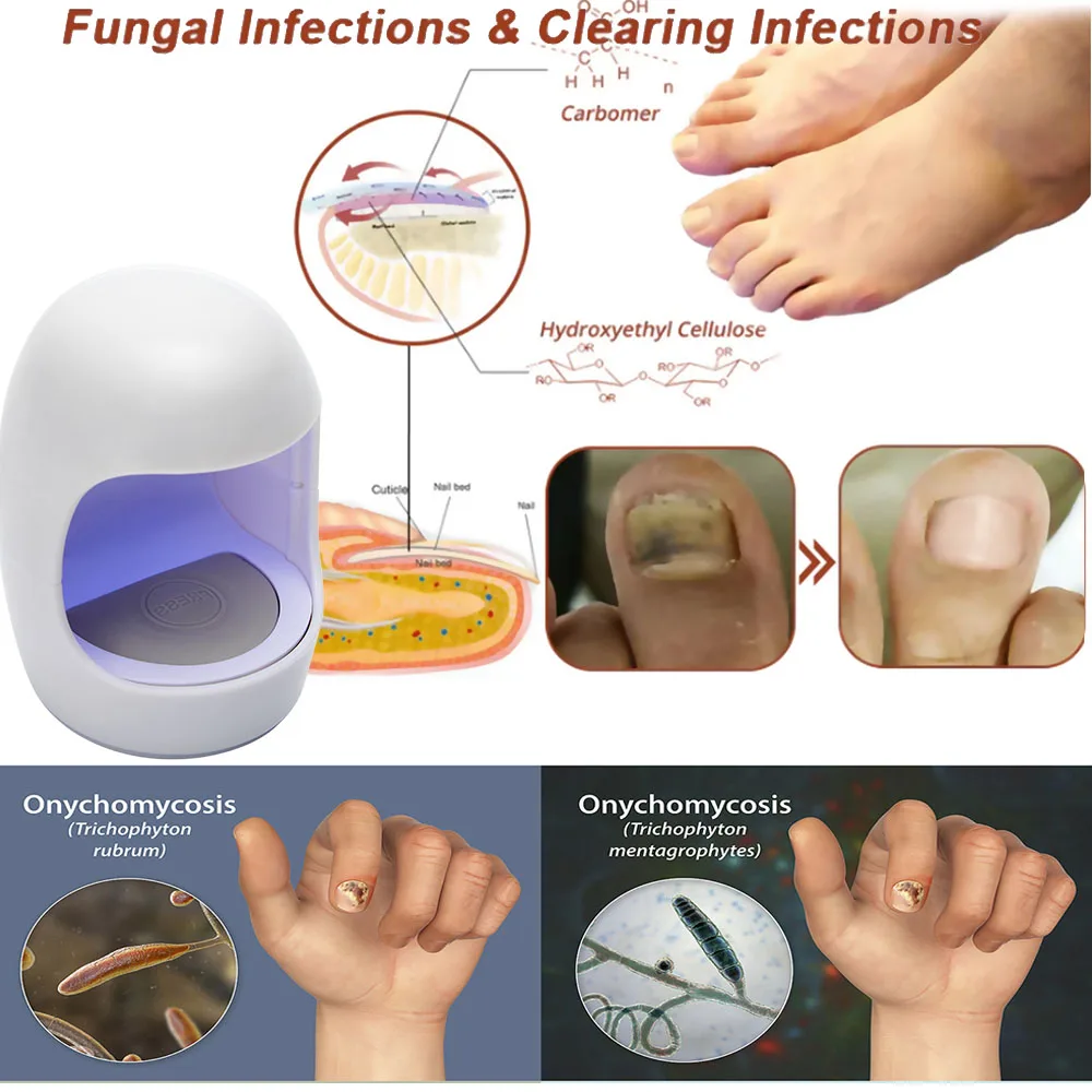 جهاز العلاج بالليزر للفطر ، إصلاح أظافر القدم ، الزيوت العطرية ، فطار الأظافر ، علاج أظافر القدم ، علاج الفطريات