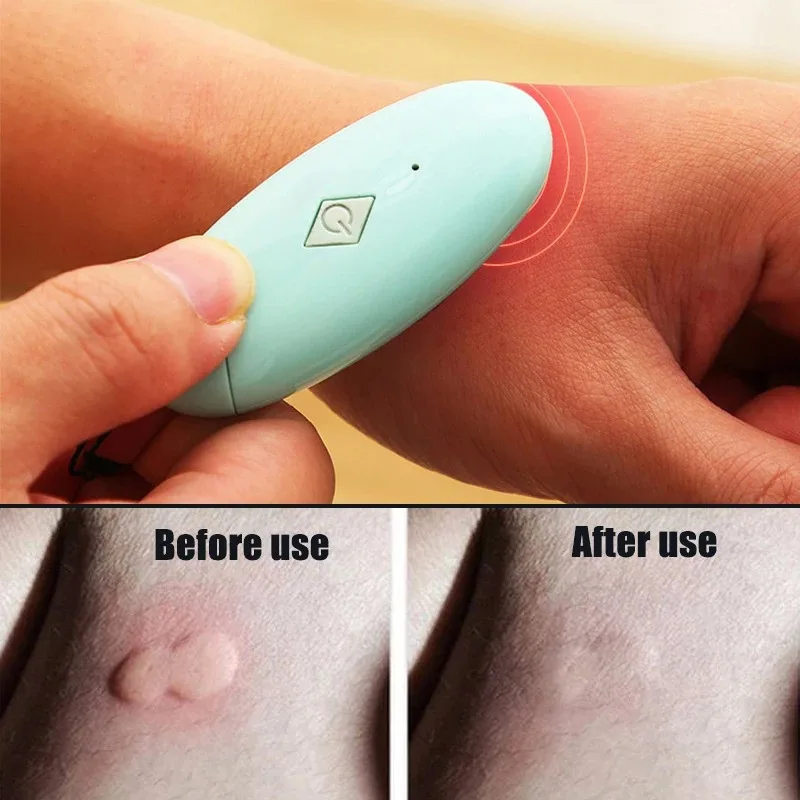 

Antipruritic Instrument, Non-Toxic Natural Relief Of Insect Bites , No Chemical Use, Relieve Itching And Swelling With Cable