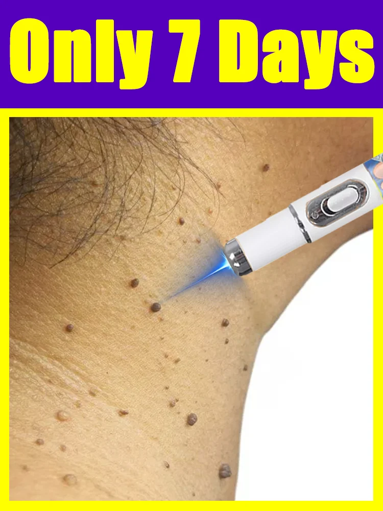 Blue Light Pen Solve Warts, Painless, Quickly, Hot Sale Wart Care Tools, Feet, Shoulders, Neck, Head