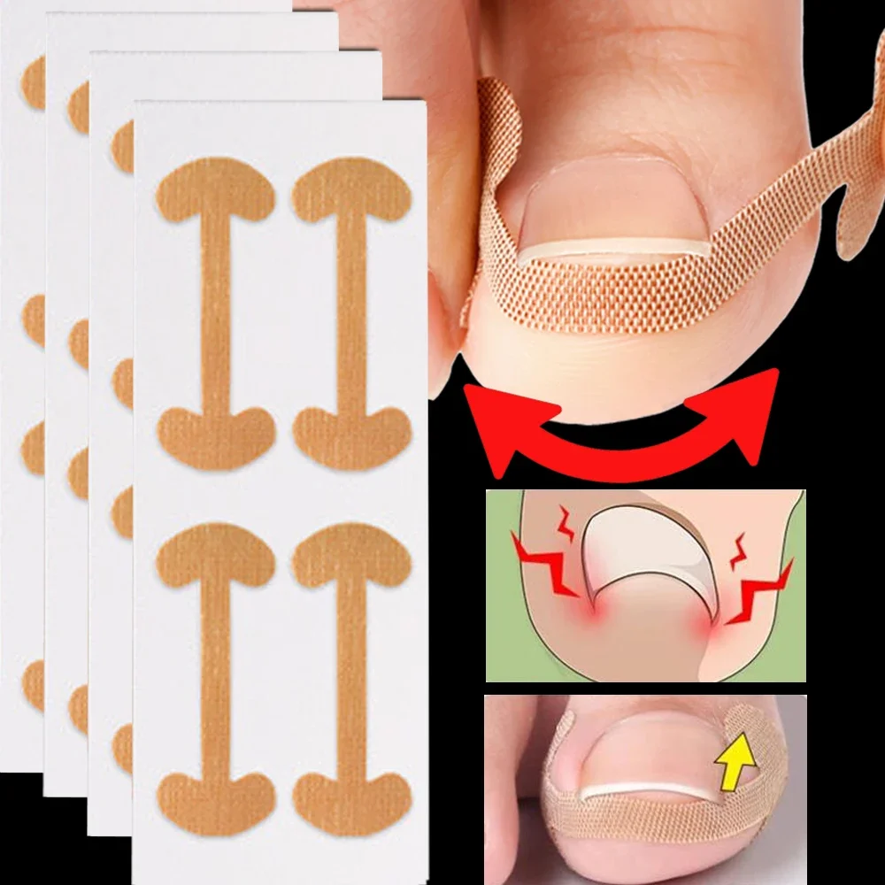 Bandes correctrices pour ongles incarnés, 100 pièces, adhérence durable, autocollants imperméables, élasticité, soins des orteils, outils de pédicure