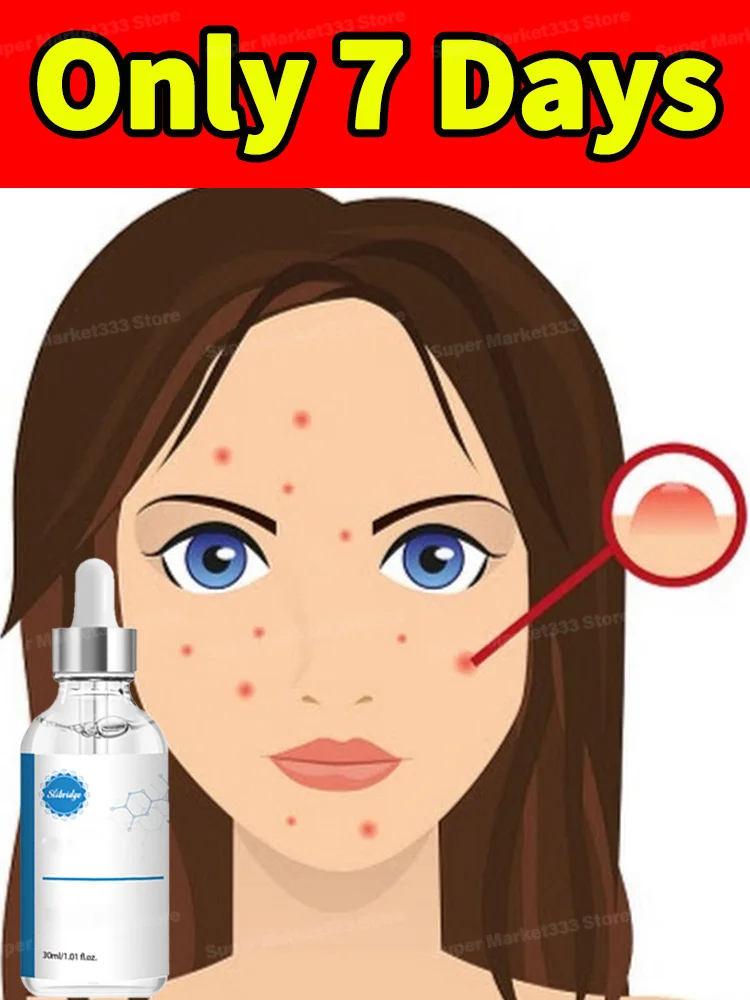 

Effectively solve acne marks in 7 days