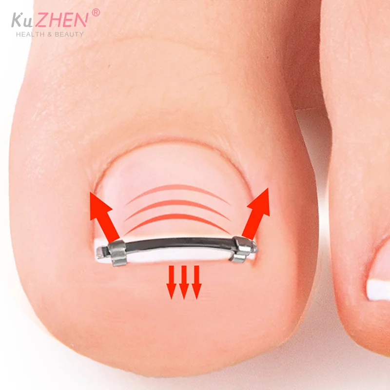 Ingrown Toenail Pedicure Tool Embed Toe Nail Care Straightening Correction Clip Curved Clamp Toenails Correction Tool For Toes