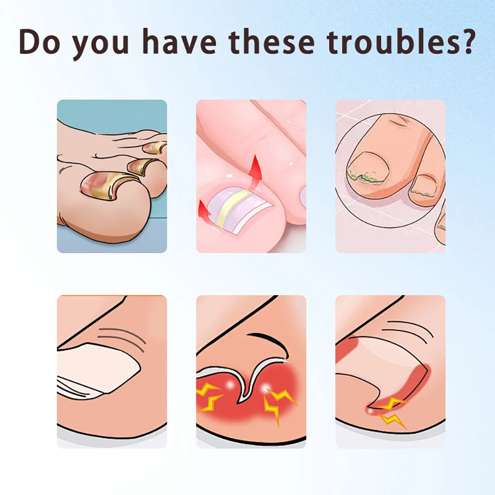 سائل إصلاح الأظافر 30 مل حل علاج فطريات الأظافر Tinea Unguium للأظافر المتغيرة اللون والتالفة