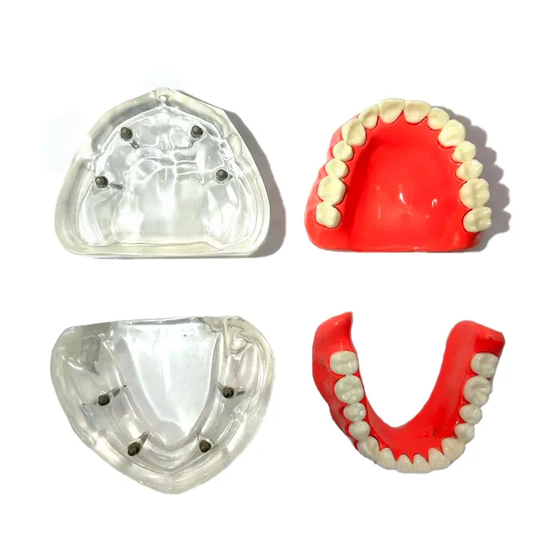 Dental Implant Model Upper/Lower Jaw Removable Implant Model With 4 Implants Overdenture Restoration Model Oral Teach Research