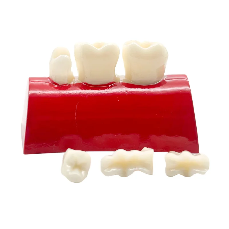 New Dental Inlay Exercise Model Block Filling Exercise Removable Typodont Resin Materials Oral Filling Model Dentist Teaching