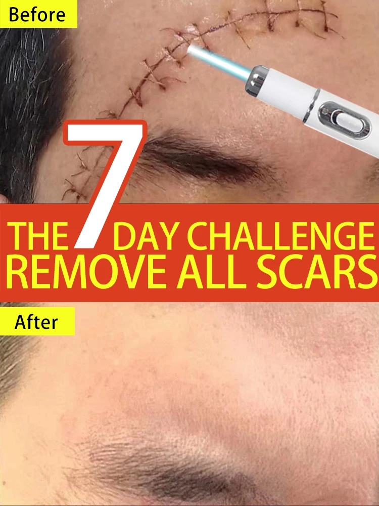 keloid scar removal lase