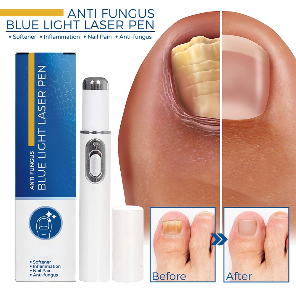 1ชิ้นปากกาการรักษาเชื้อราเล็บป้องกันเชื้อราซ่อมแซมปากกาสีฟ้า pulpen Laser paronychia เล็บ Onychomycosis กำจัดขนไม่เจ็บปวดดูแล