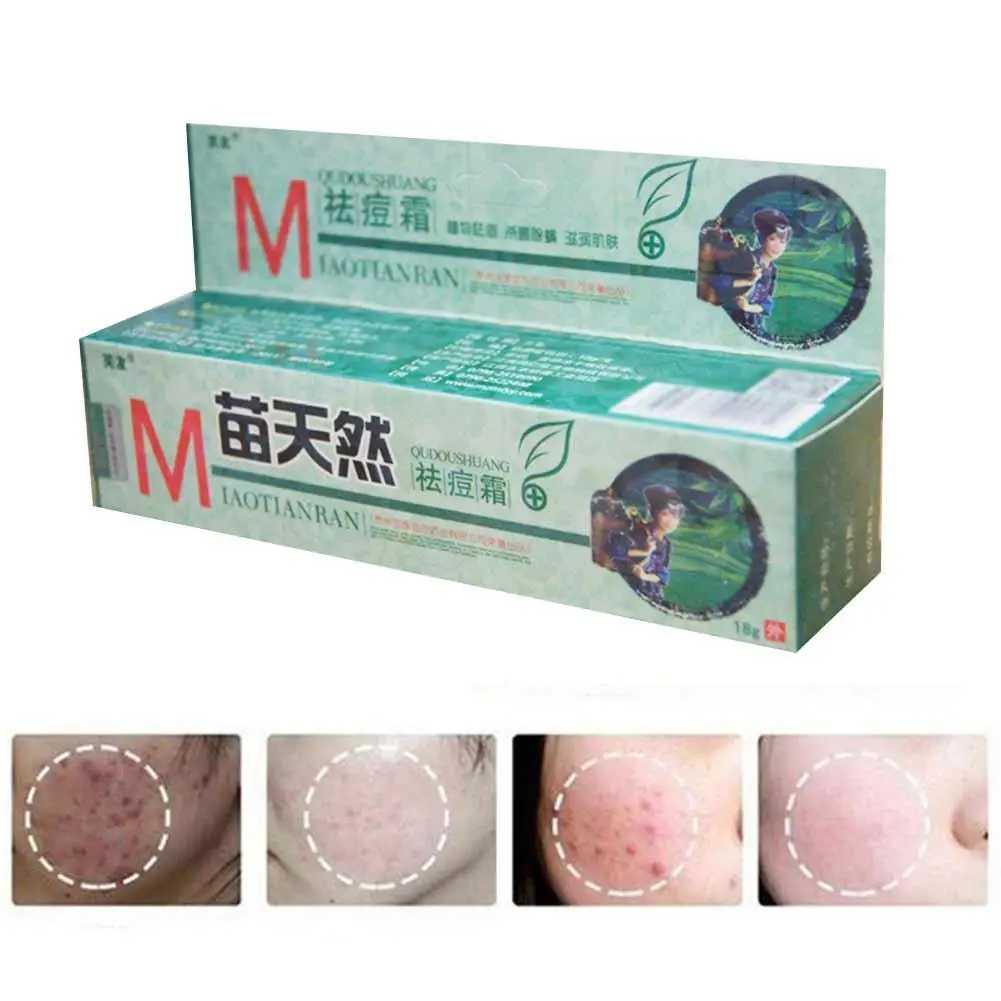 

Original Fuyou Miaotianran Remove Acne Cream Germicidal Moisturize and Mite Remove Massage Skin For Treatment Creams 1pcs